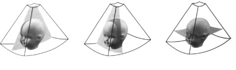 Voluson imaging diagrams depicting scans of a baby's face.